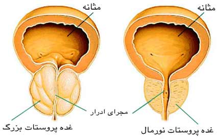 پروستاتیت : التهاب پروستات