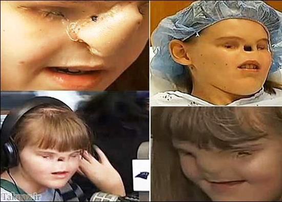 جراحی عجیب دختری که بدون چشم و بینی متولد شد!+ عکس