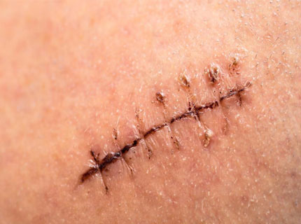 بهترین کرم برای جای بخیه عمل آپاندیس