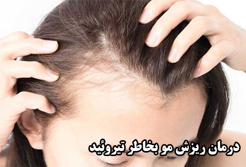درمان ریزش مو بخاطر تیروئید