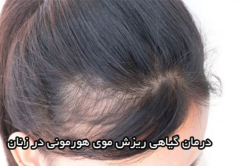 درمان گیاهی ریزش موی هورمون در زنان