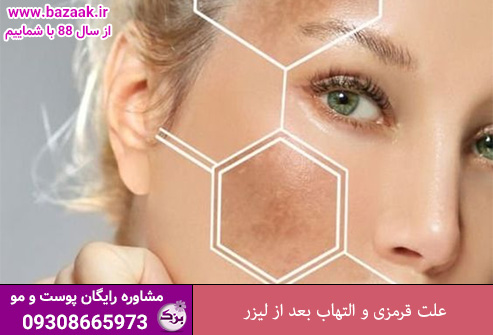 علت قرمزی و التهاب بعد از لیزر
