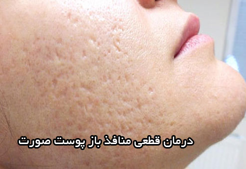 درمان قطعی منافذ باز پوست صورت