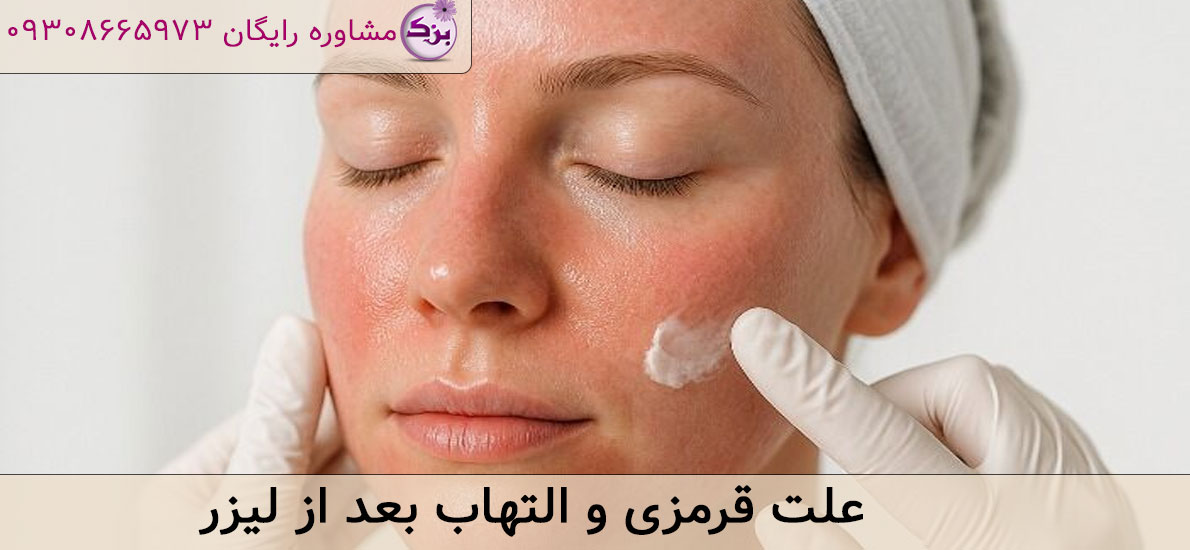 علت قرمزی و التهاب بعد از لیزر