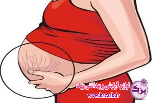 درمان ترک شکم در دوران بارداری