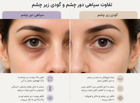 علت سیاهی دورچشم