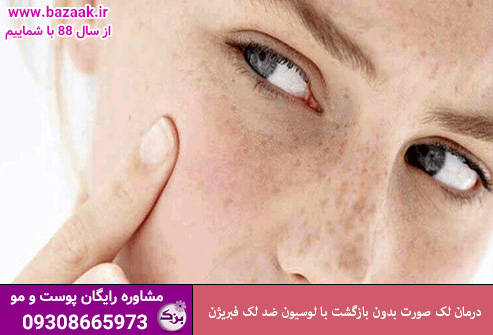 درمان لک صورت بدون بازگشت با لوسیون ضد لک فبریژن