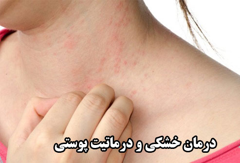 درمان خشکی درماتیت پوست