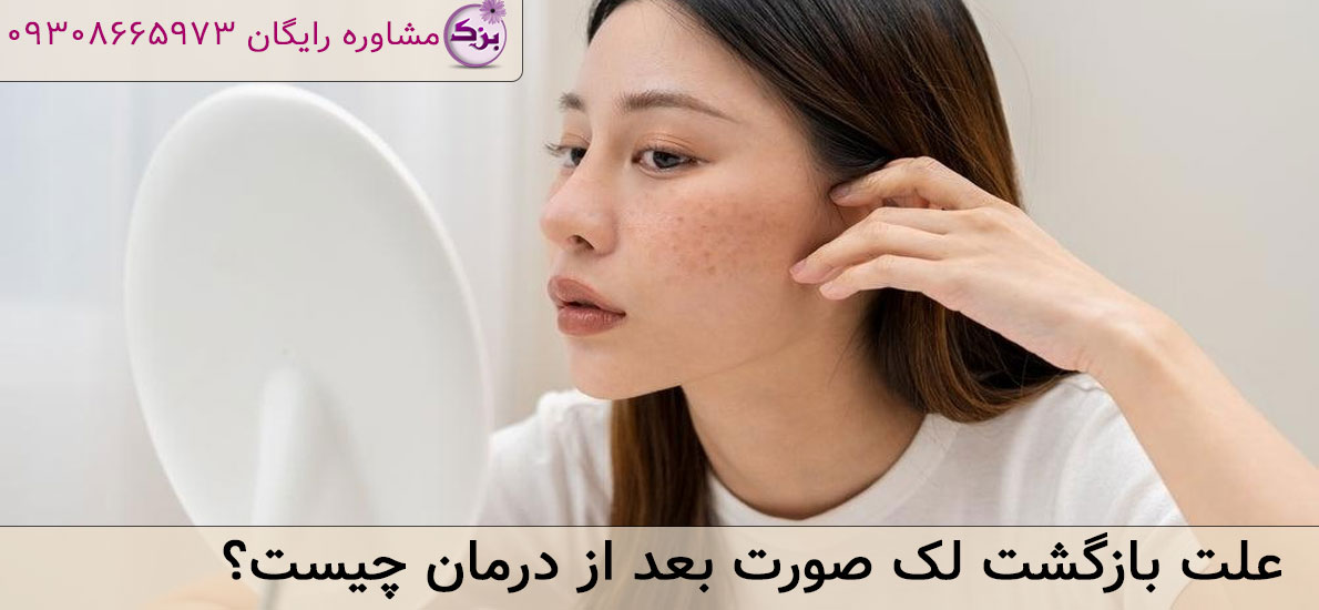 علت بازگشت لک صورت بعد از درمان چیست؟ راه‌های جلوگیری از عود لک
