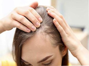 درمان ریزش مو شقیقه‌ ها