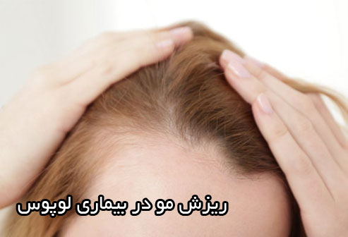 ریزش مو در بیماری لوپوس
