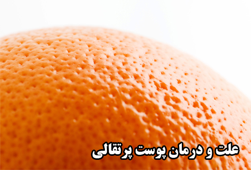 درمان پوست پرتقالی یا سلولیت