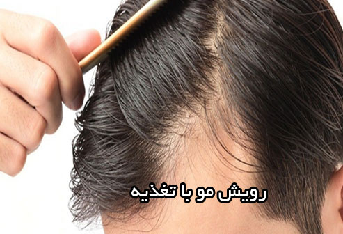ریزش مو ارثی درمان دارد