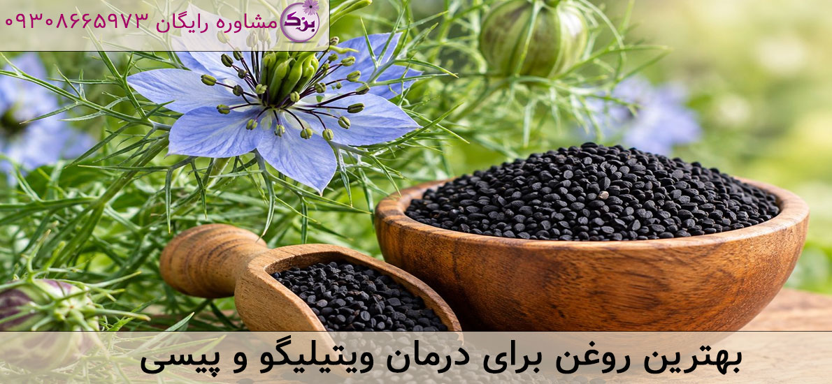 بهترین روغن برای درمان ویتیلیگو و پیسی