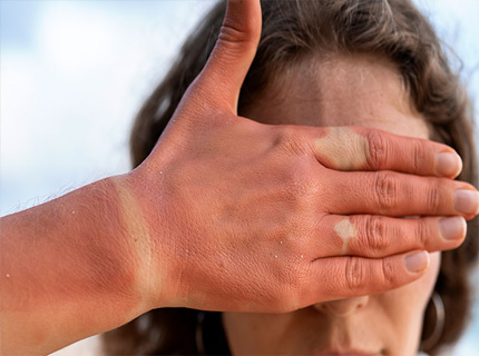 کرم آفتاب سوختگی