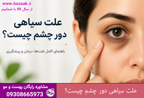 علت سیاهی دور چشم چیست؟ راهنمای کامل علت‌ ها، درمان و پیشگیری