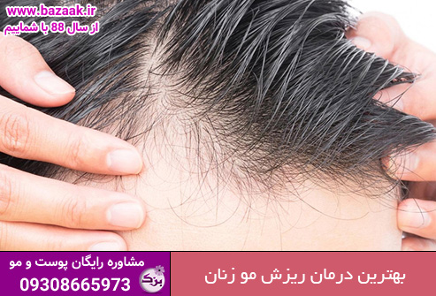بهترین درمان ریزش مو زنان